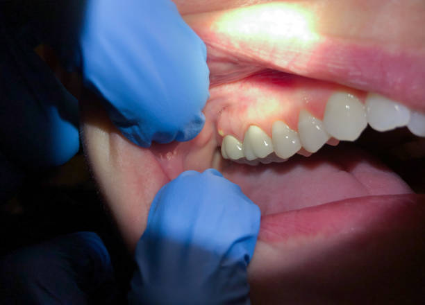 Best Emergency Wisdom Tooth Extraction in Greencastle, IN